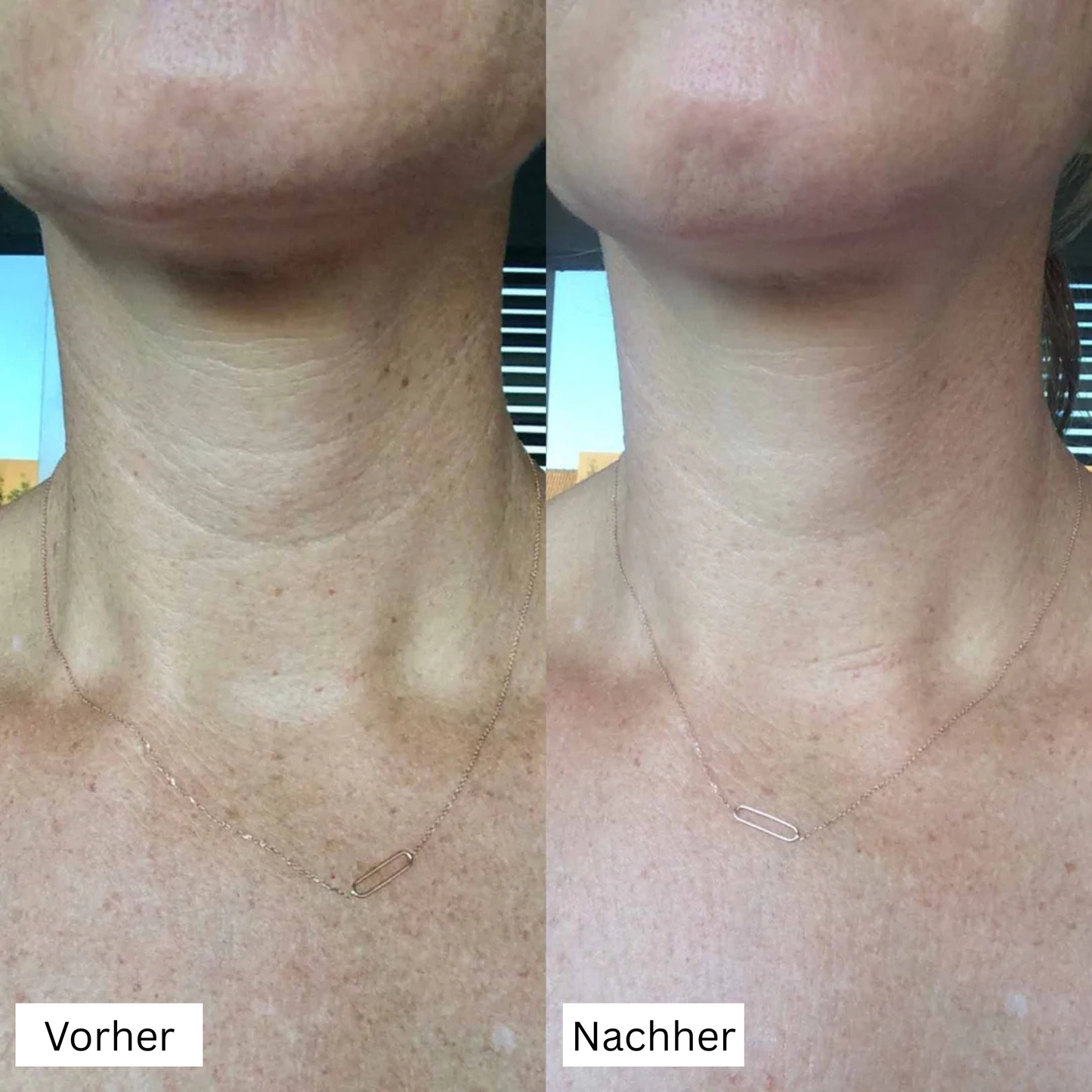 Silikon-Pads zur Falten‑ & Narbenreduktion