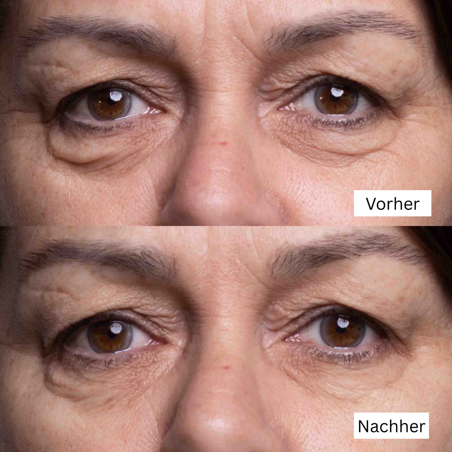 Silikon-Pads zur Falten‑ & Narbenreduktion