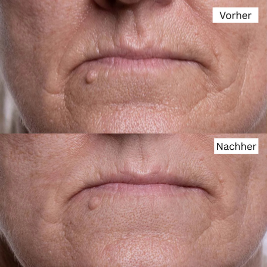 Silikon-Pads zur Falten‑ & Narbenreduktion